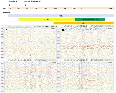 Case report: De novo variant of SETD1A causes infantile epileptic spasms syndrome
